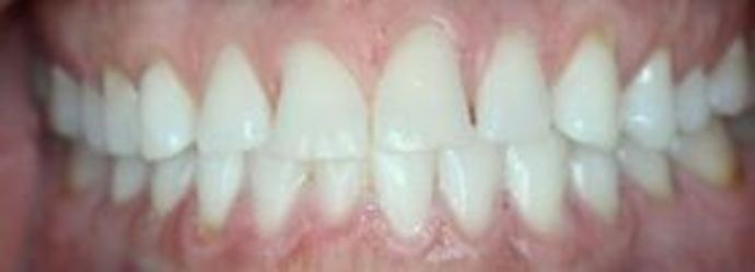 Smile Makeovers, actual cases of our dentists, no special lighting or editing Case 20 - Before