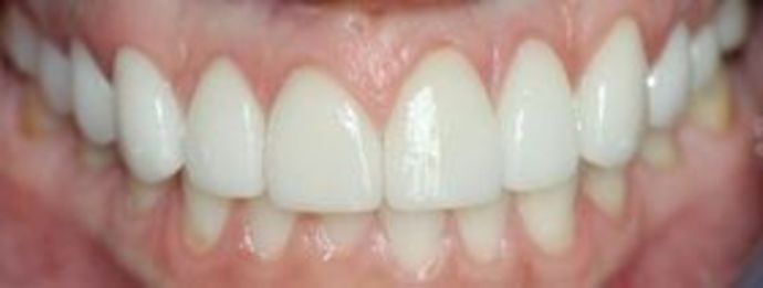 Smile Makeovers, actual cases of our dentists, no special lighting or editing Case 20 - After