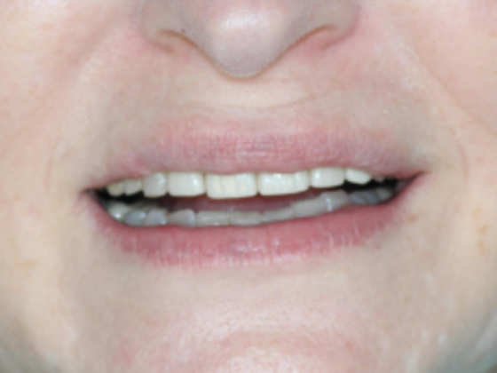 Smile Makeovers, actual cases of our dentists, no special lighting or editing Case 22 - After