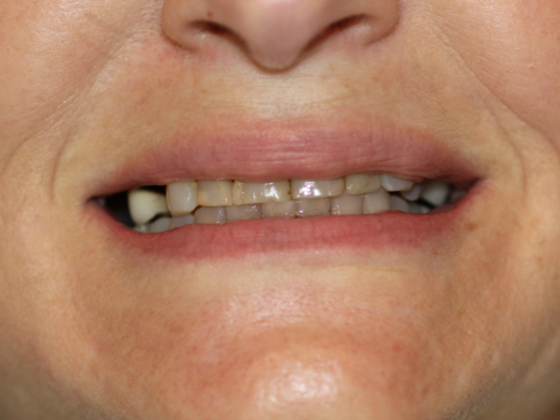 Smile Makeovers, actual cases of our dentists, no special lighting or editing Case 22 - Before