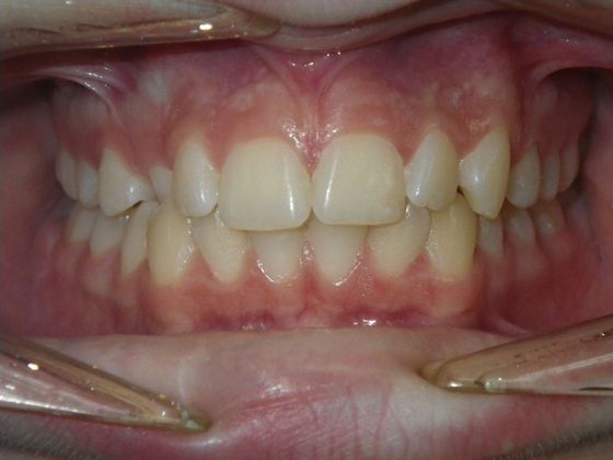 Orthodontics: Case 34 - Before