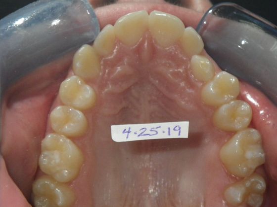 Orthodontics: Case 34 - Before