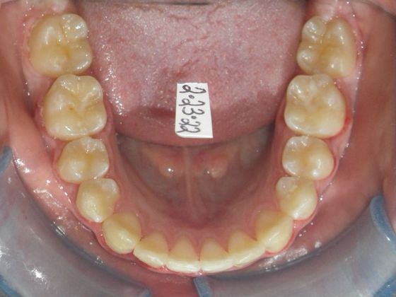 Orthodontics: Case 34 - Before