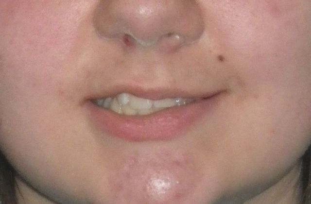 Orthodontics: Case 34 - Before