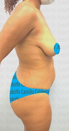 Mommy Makeover -Abdomen, Breast, Lipo, BBL-: Breast lift without implants + Tummy Tuck + Liposculpture - Before