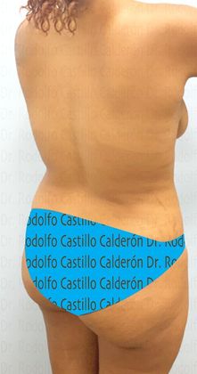 Mommy Makeover -Abdomen, Breast, Lipo, BBL-: Breast lift without implants + Tummy Tuck + Liposculpture - Before