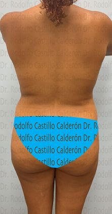 Mommy Makeover -Abdomen, Breast, Lipo, BBL-: Breast lift without implants + Tummy Tuck + Liposculpture - Before