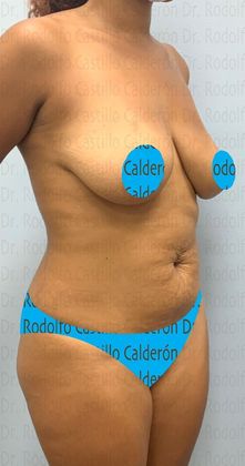 Mommy Makeover -Abdomen, Breast, Lipo, BBL-: Breast lift without implants + Tummy Tuck + Liposculpture - Before