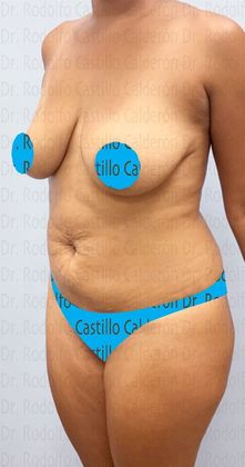 Mommy Makeover -Abdomen, Breast, Lipo, BBL-: Breast lift without implants + Tummy Tuck + Liposculpture - Before