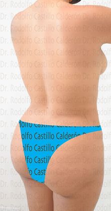 Mommy Makeover -Abdomen, Breast, Lipo, BBL-: Breast lift without implants + Tummy Tuck + Liposculpture - After