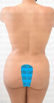Mommy Makeover -Abdomen, Breast, Lipo, BBL-: Breast lift without implants + Tummy Tuck + Liposculpture - After