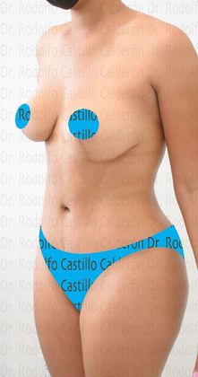 Mommy Makeover -Abdomen, Breast, Lipo, BBL-: Breast lift without implants + Tummy Tuck + Liposculpture - After