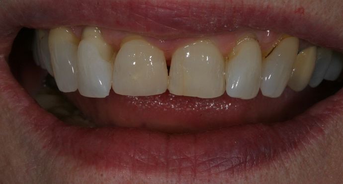 Before and After Gallery Case 7 Bonding - After