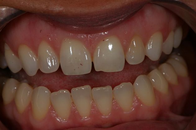 Before and After Gallery Case 8 Bonding - Before