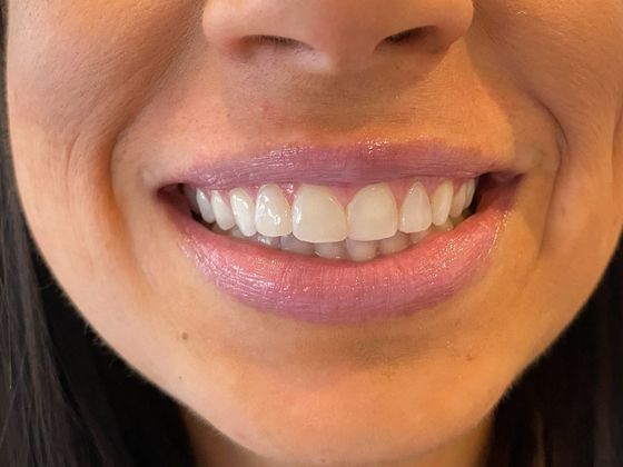 Before and After Gallery Case 8 Bonding - After