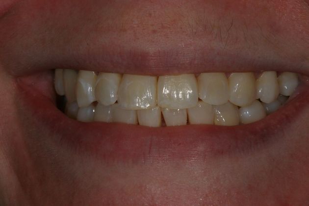 Before and After Gallery Case 9 Whitening - After