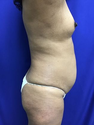Body Buttock Enhancement Case 8 (32267) - Before
