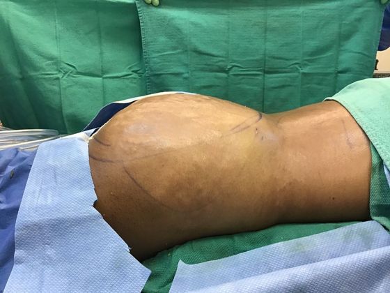 Body Buttock Enhancement: Case 8 (32267) - After, round butt, curved waist