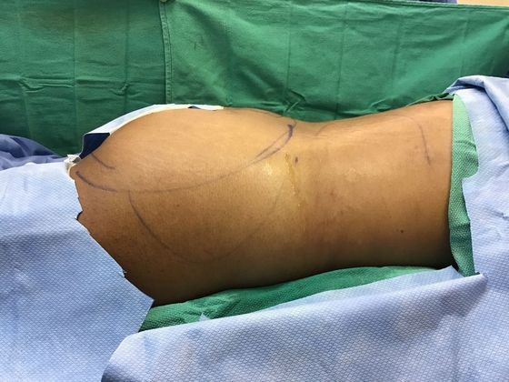 Body Buttock Enhancement: Case 8 (32267) - Before, flat butt, thick waist