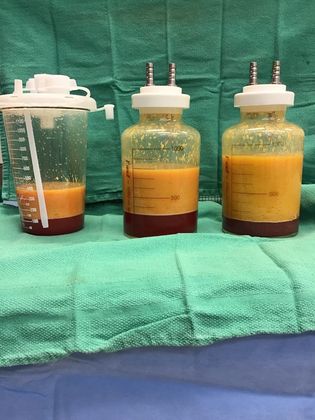 Body Buttock Enhancement: Case 8 (32267) - Fat for transfer to buttocks