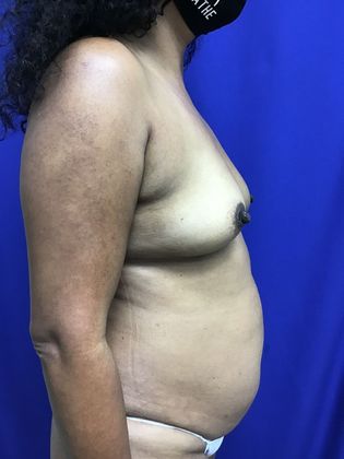 Breast Augmentation : Case 81 (32267) - Before