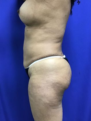 Breast Augmentation : Case 81 (32267) - After