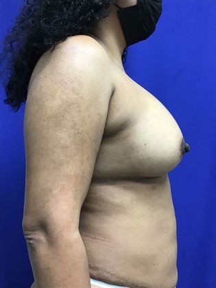 Body Mommy Make-Over: Case 11 (32267) - After