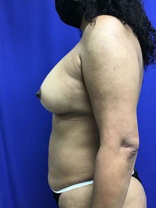 Body Mommy Make-Over: Case 11 (32267) - After