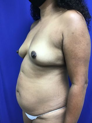 Body Mommy Make-Over: Case 11 (32267) - Before