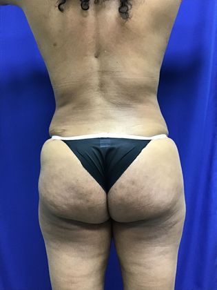 Body Mommy Make-Over: Case 11 (32267) - After