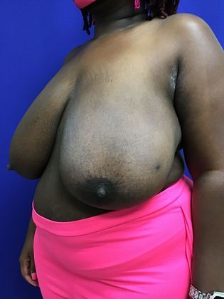Breast Reduction: Case 33 (31839) - Before