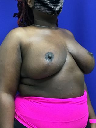 Breast Reduction: Case 33 (31839) - After