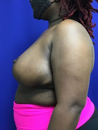 Breast Reduction: Case 33 (31839) - After