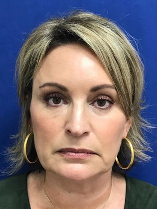 Injectables Botox, Dysport Neuromodulators: Case 8 (31821) - After