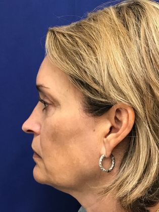 Injectables Botox, Dysport Neuromodulators: Case 8 (31821) - Before