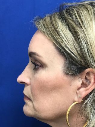 Injectables Botox, Dysport Neuromodulators: Case 8 (31821) - After