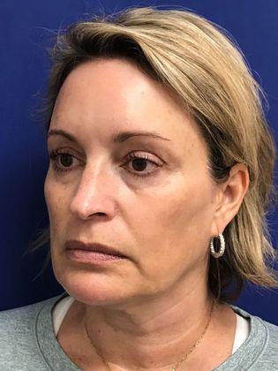 Injectables Botox, Dysport Neuromodulators: Case 8 (31821) - Before