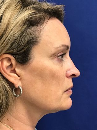 Injectables Botox, Dysport Neuromodulators: Case 8 (31821) - Before