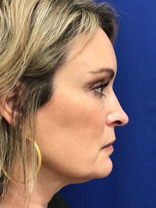 Injectables Botox, Dysport Neuromodulators: Case 8 (31821) - After