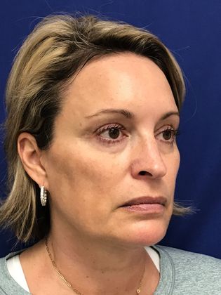 Injectables Botox, Dysport Neuromodulators Case 8 (31821) - Before