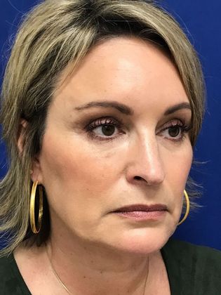 Injectables Botox, Dysport Neuromodulators Case 8 (31821) - After