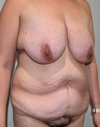 Mommy Makeover: Case 220 - Before