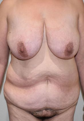Massive Weight Loss : Case 95 - Before