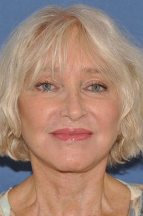 Facelift: Browlift and facelift - After at 71.5 yo