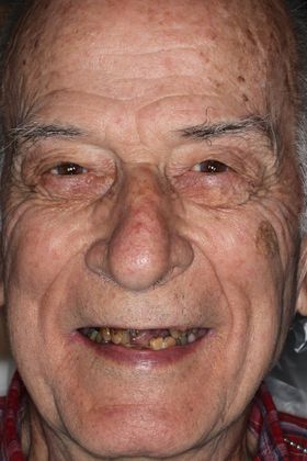 Dentures Case 8 - Before