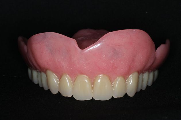 Dentures: Case 8 - Upper Denture