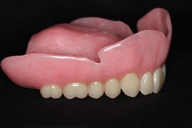 Dentures: Case 8 - Upper Denture