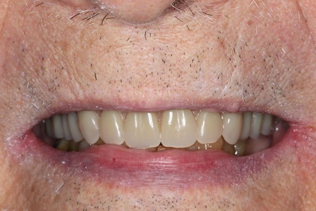 Dentures: Case 8 - After