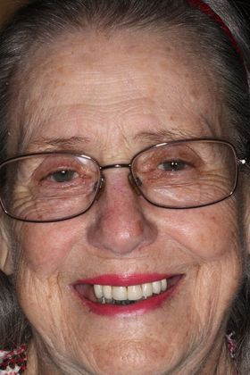 Dentures Case 9 - Before