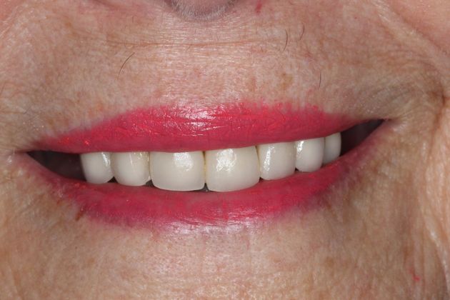 Dentures: Case 9 - Before